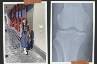 На чотирьох ортопедів — три різні думки. Історія однієї травми коліна, яка насправді про всіх нас