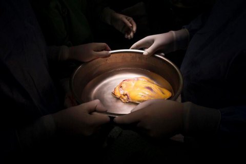 Від серця до серця: що відбувається з пересадками органів в Україні