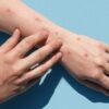 Віспа мавп в Україні. 7 запитань і відповідей про хворобу, симптоми і загрози