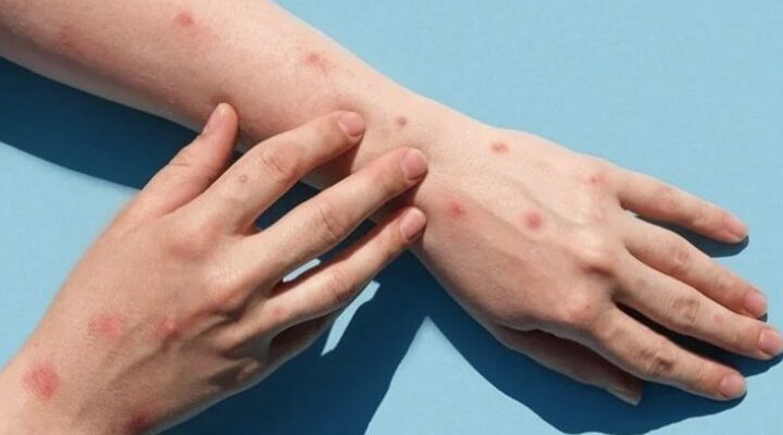 Віспа мавп в Україні. 7 запитань і відповідей про хворобу, симптоми і загрози