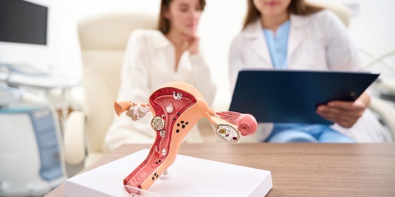 Синдром поликистозных яичников