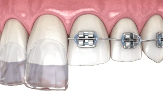 ортодонтична корекція