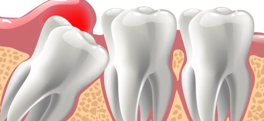 Видалення ретинованого зуба